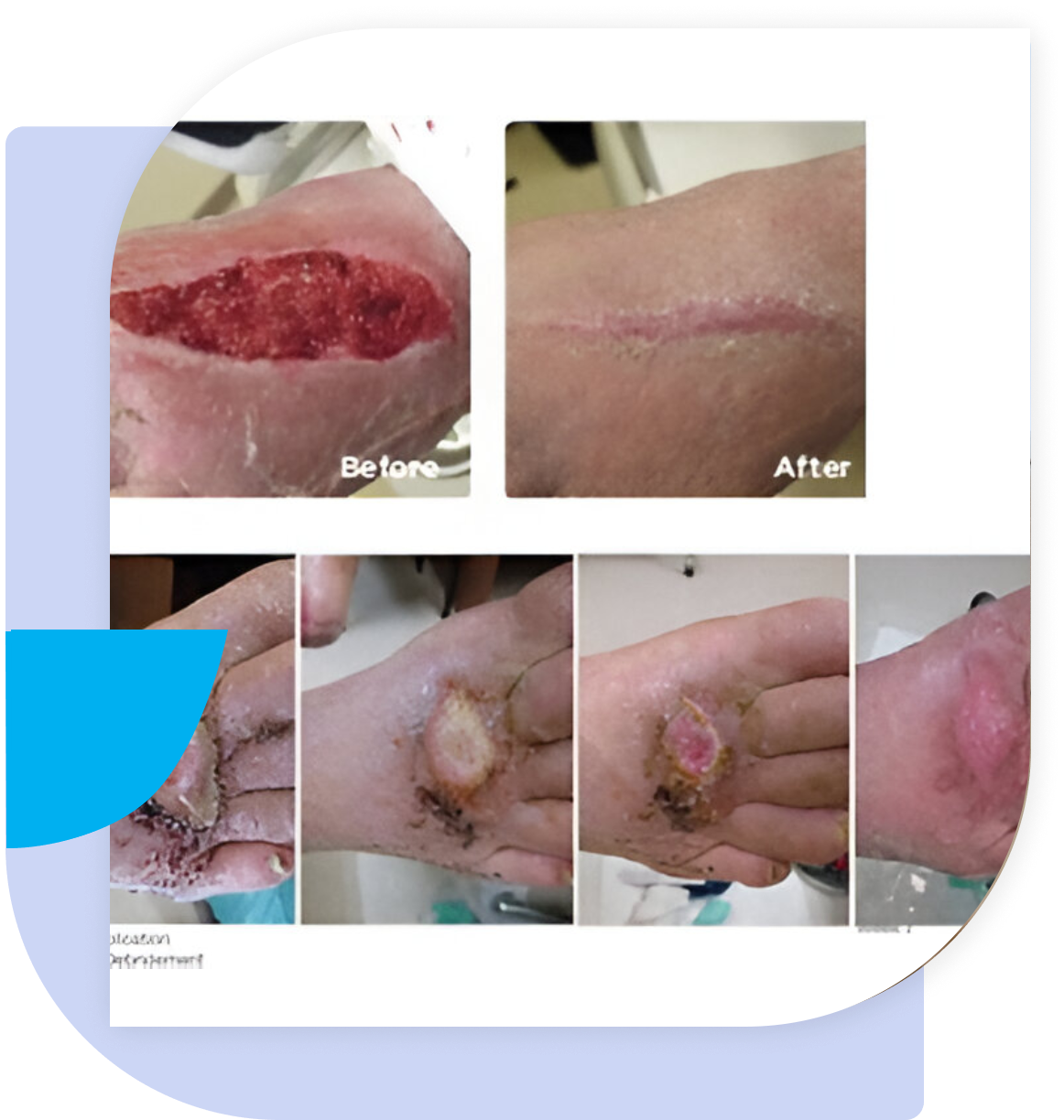 A collage of photos showing the process of removing an infected wound.
